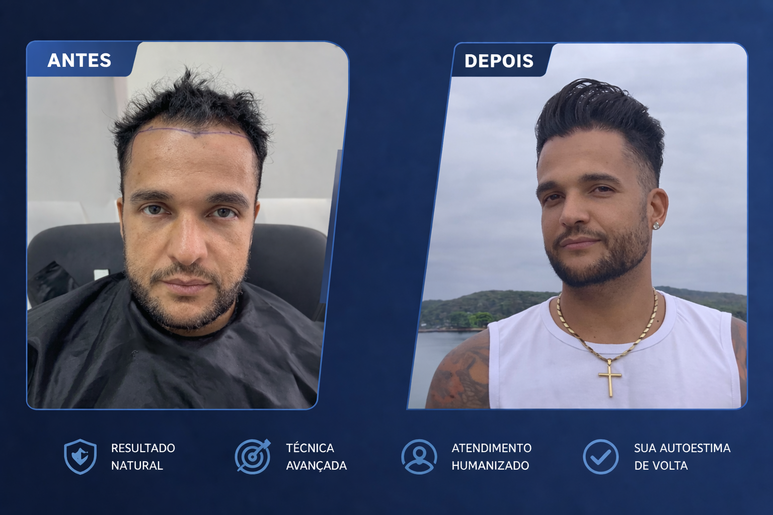 Resultado real de transplante capilar 1